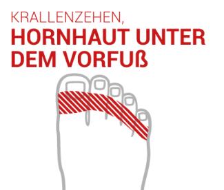 Krallenzeh Hammerzeh verkrümmte Zehen